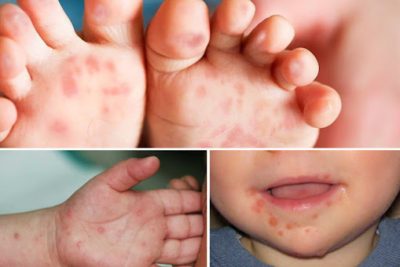 Bài tuyên truyền phòng chống chân tay miệng